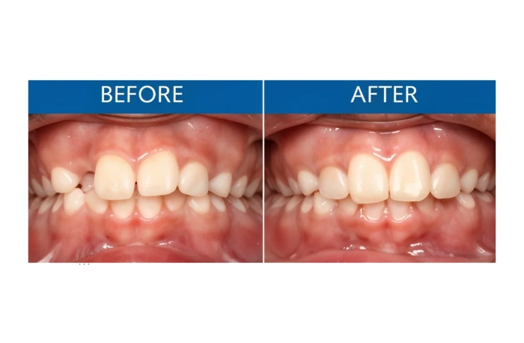 Kids Early Crossbite Treatment in ChennaI