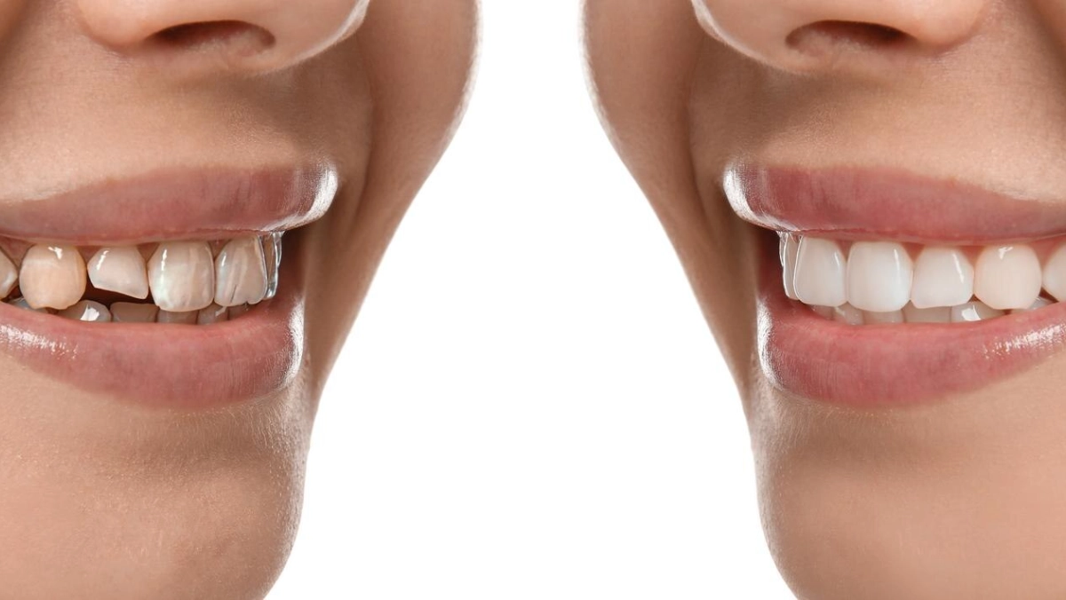 full mouth reconstruction cost